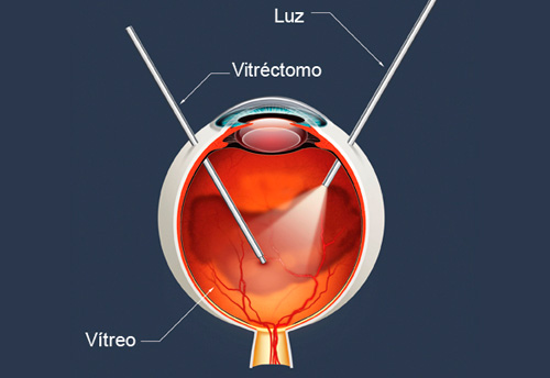 Vitrectomia anterior