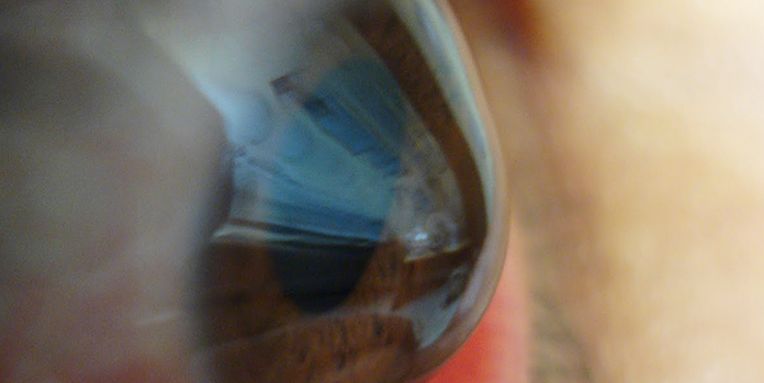 Ceratocone - DoenÃ§a ocular deforma a cÃ³rnea e pode causar sÃ©rios danos Ã  visÃ£o